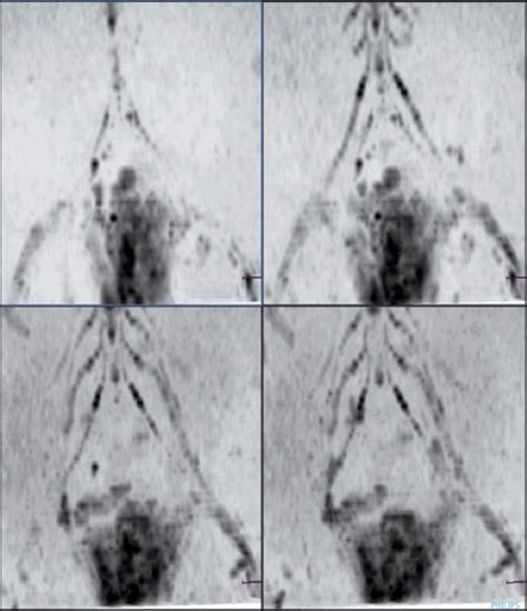 Figure From Utilidad De Las Secuencias De Difusi N En Resonancia