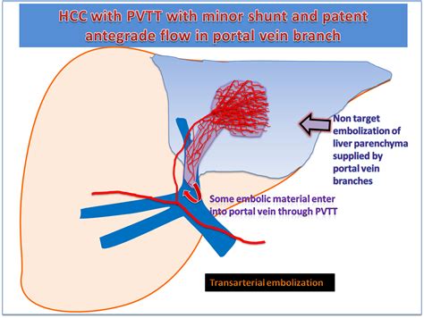 Ecr 2012 C 1368 Portal Vein Tumour Thrombosis In Hepatocellular