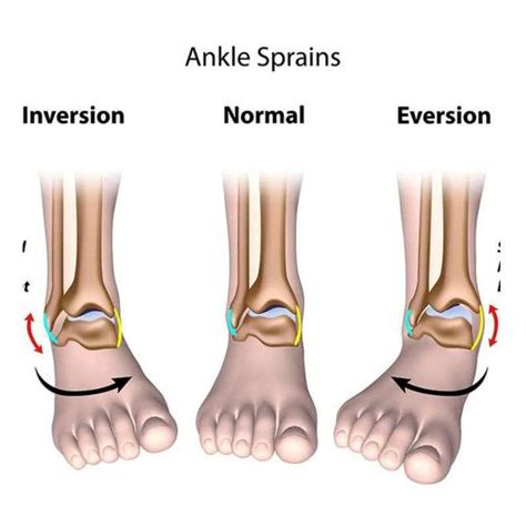 Ankle Sprains Ligament Tears - Orthosports