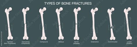 Types of bone fracture. Structure of a bone vector illustration. The ...