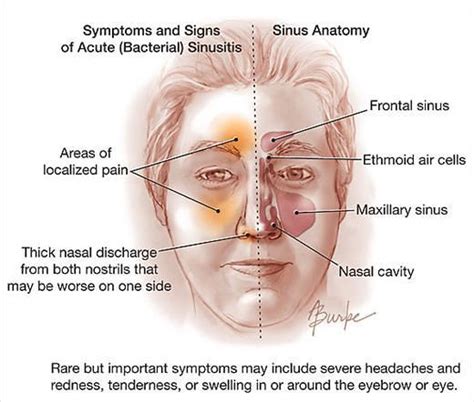 Sinus Infection Treatment Post Nasal Drip Treatment Sinusitis Symptoms