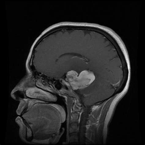 Ruptured Intracranial Dermoid Cyst Image