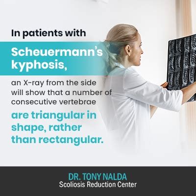 Kyphotic Curve: What Is Kyphosis Of The Spine & Treatment