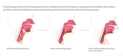 Total Laryngectomy