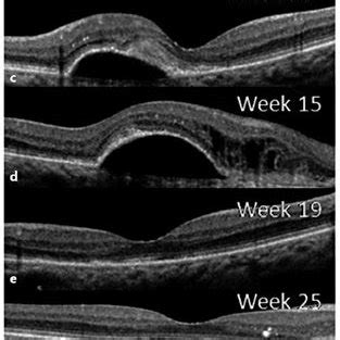 Macular OCT demonstrating subfoveal fluid and pigment epithelial ...