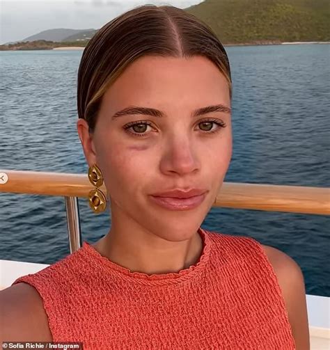 Sofia Richie Is Left With A Black Eye After Wakeboarding Accident As