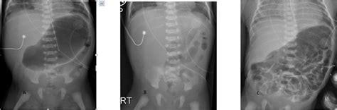 A C Progression Of The Abdominal X Ray From An Appearance Of Gastric