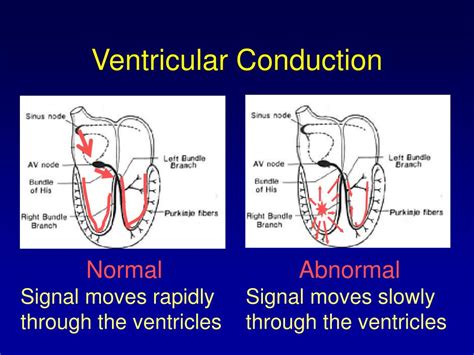 Ppt Ecg Rhythm Interpretation Powerpoint Presentation Free Download