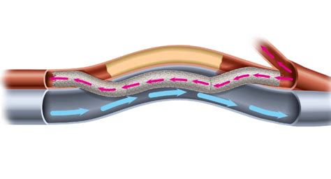 pq bypass earns breakthrough designation  fully percutaneous femoral