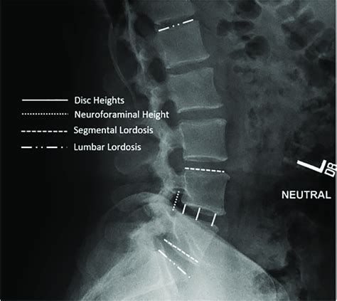 Lateral Lumbar Spine Xray