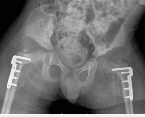 AP Radiograph Of The Pelvis At 3 Weeks Follow Up Demonstrating