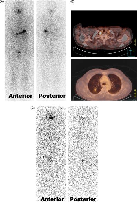 Clinical Implication Of F 18 Fdg Petct For Differentiated Thyroid