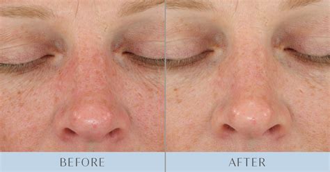 DiamondGlow: Before & After - Southeastern Dermatology