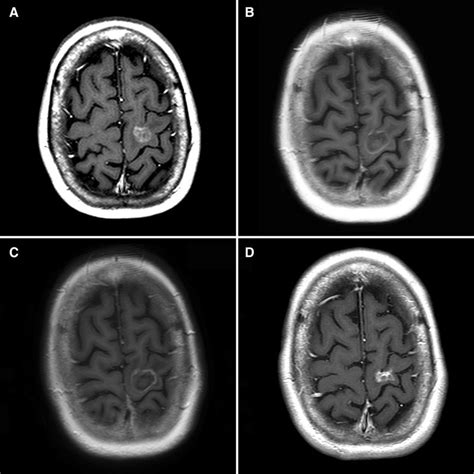 Axial T1 Weighted Magnetic Resonance Imaging With Contrast Of Patient