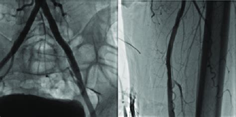 Final Result Of Successful Revascularization Of Bilateral Common Iliac