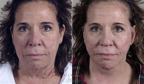 Facelift Before And After Pictures Case 46 Paramus Nj Parker Center For Plastic Surgery