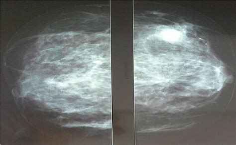 Mammographie De La Patiente Montrant Un Nodule Au Niveau Du Quadrant