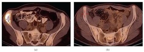 The Same Patient As On Figure 1 Bone Metastasis In The Right Iliac Download Scientific Diagram