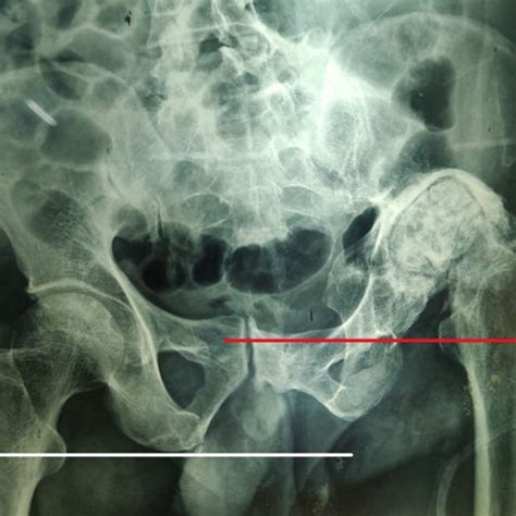 Pelvis AP X Ray Taken 4 Weeks Post Application Of Skeletal Traction