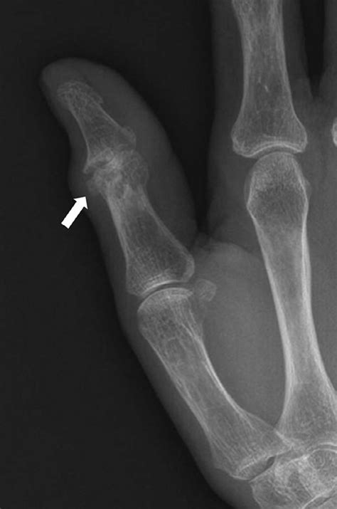 Oblique Radiograph Showing An Acute Calcific Periarthritis With A