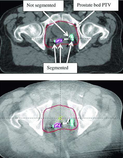 Axial View Of One Computed Tomography Slice Through The Prostate Bed Download Scientific