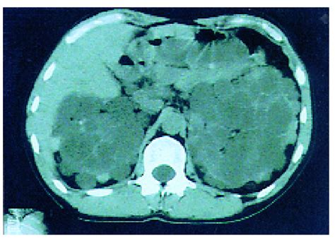 Tomodensitom Trie Abdominale Pr Op Ratoire Montrant Deux Volumineux