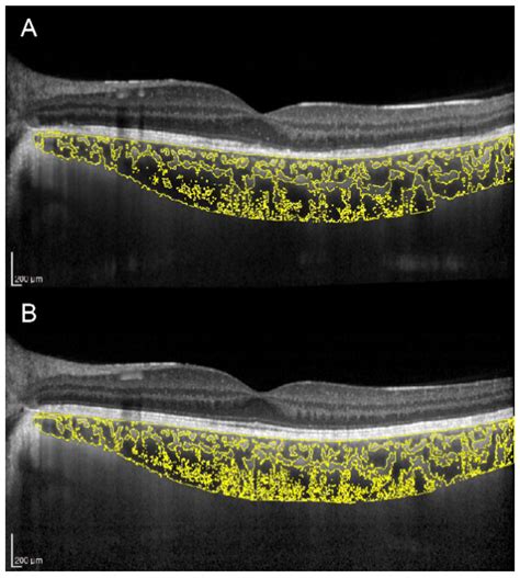 Jcm Free Full Text Choroidal Vascularity Index An In Depth Analysis Of This Novel Optical