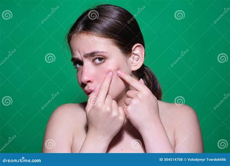 Sad Woman Squeeze Out Pimples On Cheek Acne And Pimple On Skin Dermatology Puberty Woman