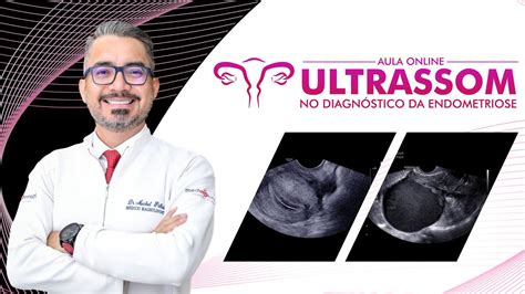 AULA 1 ULTRASSOM NO DIAGNÓSTICO DE ENDOMETRIOSE I Prof Dr Michel