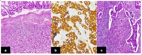 a) Poorly differentiated carcinoma composed of large cells with large ...