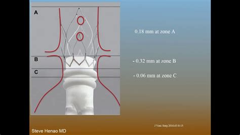 Polymer Approaches To Evar Ovation Stent Graft And Nellix Endobags