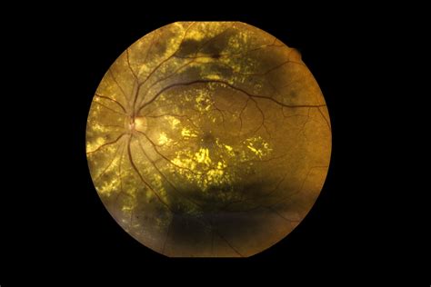 View inside human eye disorders showing retina, optic nerve and macula ...