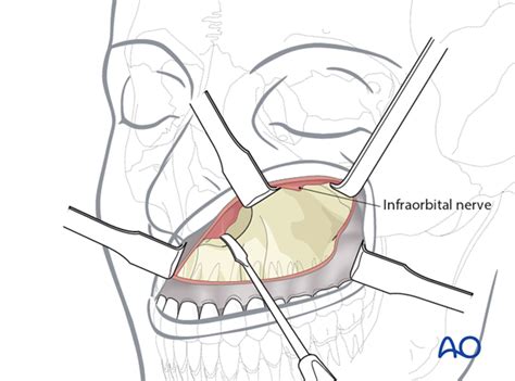 mid face degloving approach unmask ins  exs  sinus access