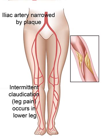 Aortoiliac Occlusive Disease - Conditions and Treatments - LA Vascular ...