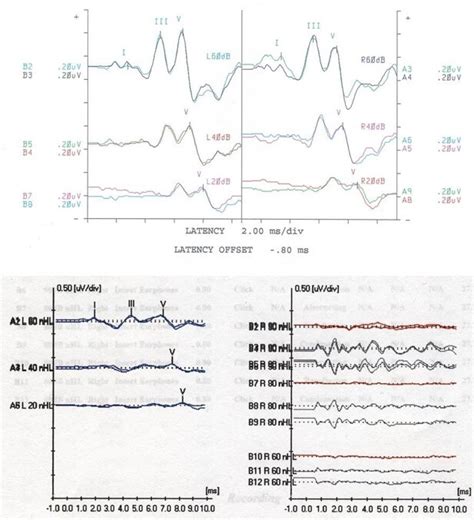 Figure Normal Abr In Top Figure Statpearls Ncbi Bookshelf