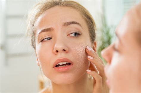 Topical Benzoyl Peroxide For Acne Science Benefits Safety Tips