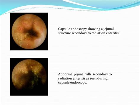 Ppt Radiation Enteritis Proctitis Powerpoint Presentation Id2083791