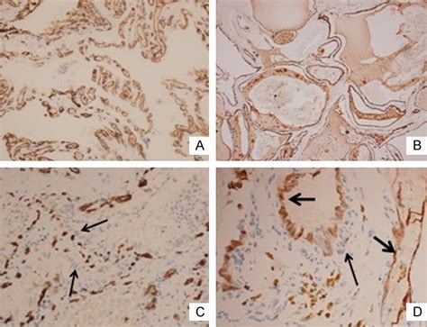 Immunophenotype of endolymphatic sac tumor. A: The CD31+ vascular cells ... 