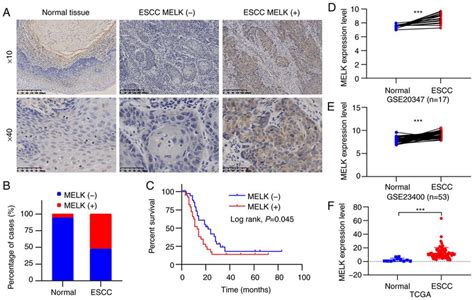 Melk Expression Is Elevated And Associated With Poor Prognosis In Escc