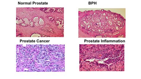 Prostate Inflammation And Prostate Cancer What Do I Need To Know