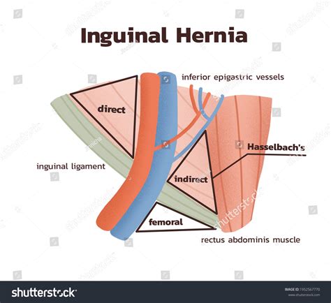 Una M Nima Ilustraci N De Hernia Inguinal Ilustraci N De Stock