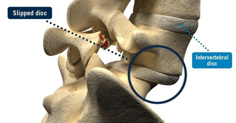 Slipped Disc Symptoms Causes And Treatment Spinal Backrack