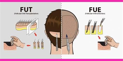 Difference Between Fut And Fue Hair Transplant Technique