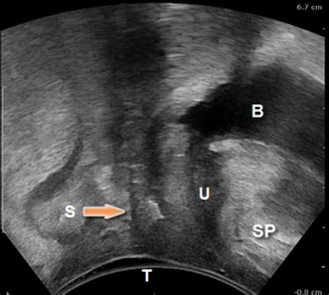 Part Transperineal And Endovaginal Ultrasound Imaging Of Slings