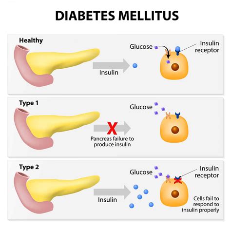 Does the Pancreas Produce Insulin? What the Pancreas Does!