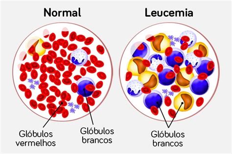 Leucemia Linfoide Aguda