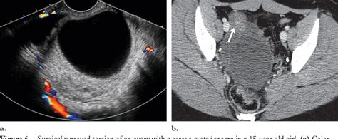 ovarian torsion | Semantic Scholar