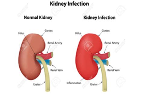 Upper Urinary Tract Infection Kidney Infection