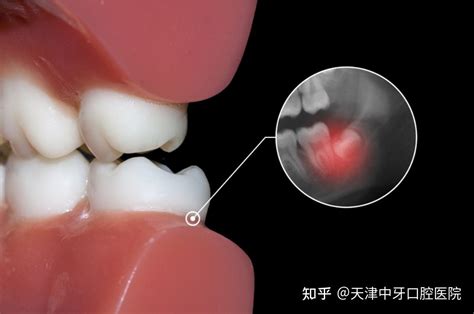 拔智齿会瘦脸吗？ 知乎