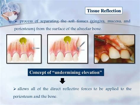 Endodontic Surgery